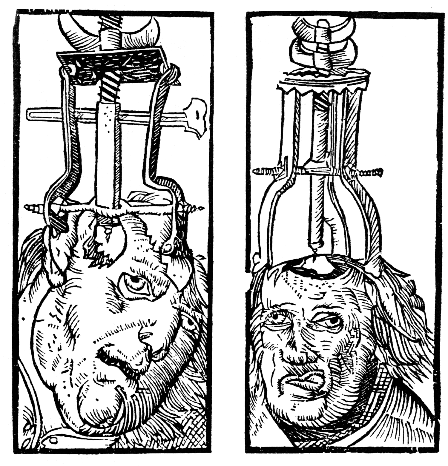 1525 engraving of trepanation